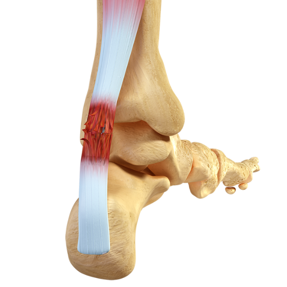 3d imagery of an injured achilles